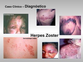 Caso Clínico –  Diagnóstico   Herpes Zoster 