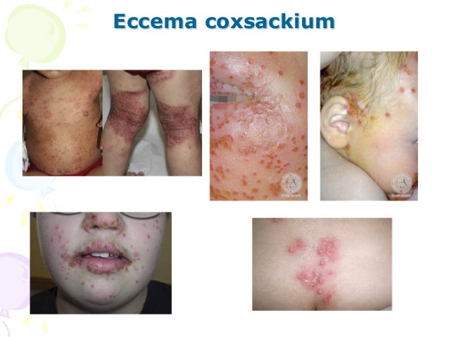 Si es posible hacer la inoculación a atopicheskom la dermatitis komarovsky