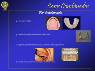 Casos CombinadosUGMA
Plan de tratamiento
4. Impresión Maxilar
5. Prueba de la Armazón (estructura metálica)
6. Registro de la relación maxilar y selección de dientes posteriores
7. Prueba estética y verificación de la relación maxilar
 