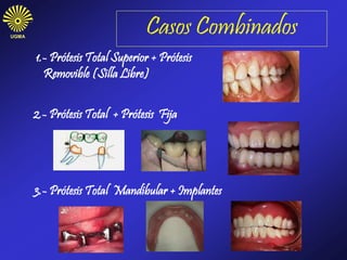 Casos CombinadosUGMA
1.- Prótesis Total Superior + Prótesis
Removible (Silla Libre)
2.- Prótesis Total + Prótesis Fija
3.- Prótesis Total Mandibular + Implantes
 