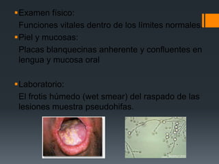 Examen físico:
 Funciones vitales dentro de los límites normales.
Piel y mucosas:
 Placas blanquecinas anherente y confluentes en
 lengua y mucosa oral

Laboratorio:
 El frotis húmedo (wet smear) del raspado de las
 lesiones muestra pseudohifas.
 
