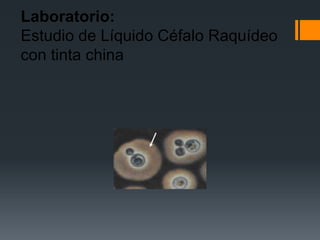Laboratorio:
Estudio de Líquido Céfalo Raquídeo
con tinta china
 