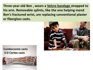 Three-year-old Ben , wears a Velcro bandage strapped to
his arm. Removable splints, like the one helping mend
Ben's fractured wrist, are replacing conventional plaster
or fiberglass casts.
Cumbersome casts
3-D Cortex casts
 
