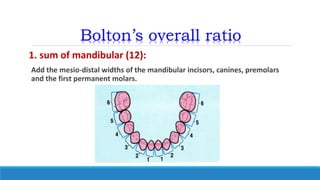 Bolton’s overall ratio
1. sum of mandibular (12):
Add the mesio-distal widths of the mandibular incisors, canines, premolars
and the first permanent molars.
 