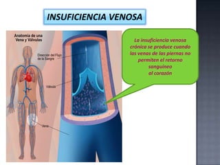 INSUFICIENCIA VENOSA
La insuficiencia venosa
crónica se produce cuando
las venas de las piernas no
permiten el retorno
sanguíneo
al corazón

 