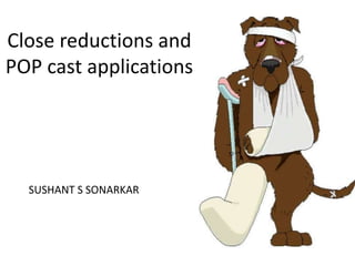 Close reductions and
POP cast applications
SUSHANT S SONARKAR
 