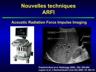 Nouvelles techniques
             ARFI
Acoustic Radiation Force Impulse Imaging




              Friedrich-Rust et al. Radiology 2009 ; 252: 595-604.
              Lupsor et al. J Gastrointestin Llver Dis 2009; 18: 303-10
 