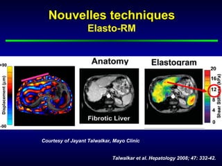 Nouvelles techniques
                                       Elasto-RM


+90
Displacement (µm)




-90


                    Courtesy of Jayant Talwalkar, Mayo Clinic


                                                 Talwalkar et al. Hepatology 2008; 47: 332-42.
 