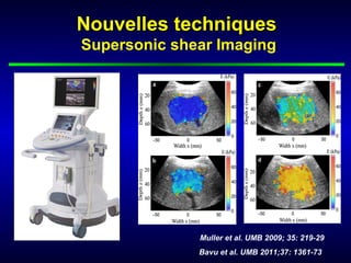 Nouvelles techniques
Supersonic shear Imaging




              Muller et al. UMB 2009; 35: 219-29
              Bavu et al. UMB 2011;37: 1361-73
 