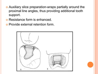  Auxiliary slice preparation-wraps partially around the
  proximal line angles, thus providing additional tooth
  support.
 Resistance form is enhanced.

 Provide external retention form.
 