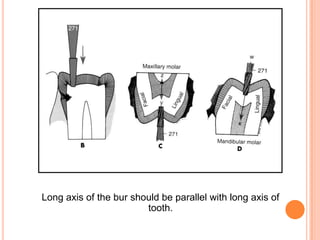 Long axis of the bur should be parallel with long axis of
                        tooth.
 