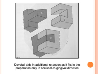 Dovetail aids in additional retention as it fits in the
 preparation only in occlusal-to-gingival direction
 