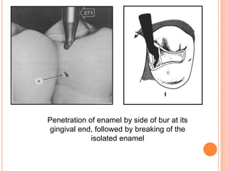 Penetration of enamel by side of bur at its
gingival end, followed by breaking of the
             isolated enamel
 