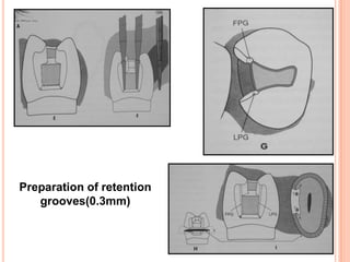 Preparation of retention
   grooves(0.3mm)
 