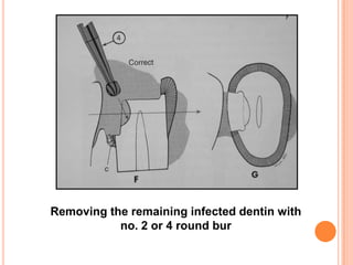 Removing the remaining infected dentin with
           no. 2 or 4 round bur
 