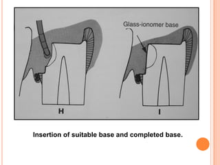 M




    Insertion of suitable base and completed base.
 