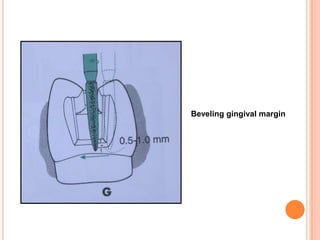 Beveling gingival margin
 