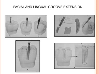FACIAL AND LINGUAL GROOVE EXTENSION
 
