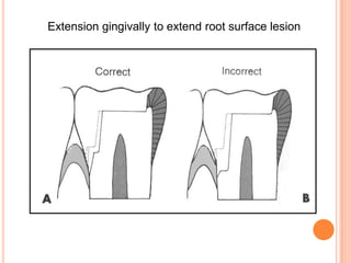 Extension gingivally to extend root surface lesion
 
