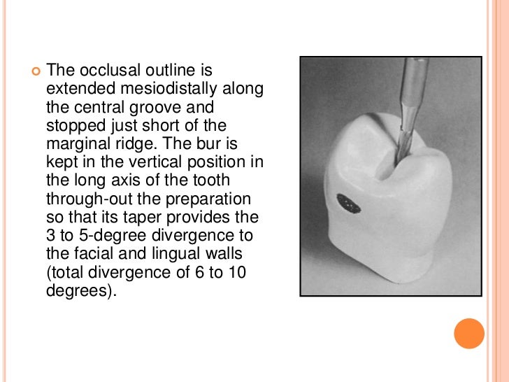 Cast gold Inlay restorations