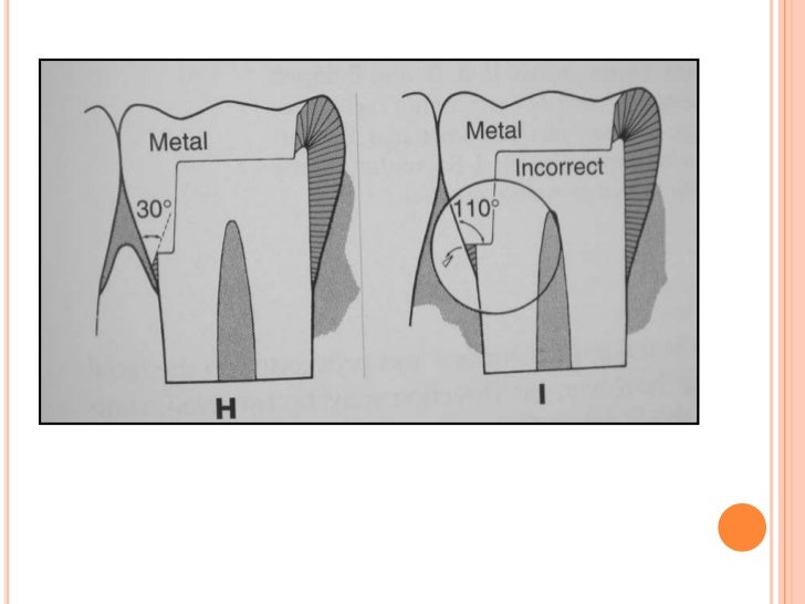 Cast gold Inlay restorations