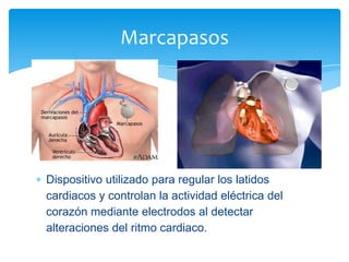 Marcapasos

Dispositivo utilizado para regular los latidos
cardiacos y controlan la actividad eléctrica del
corazón mediante electrodos al detectar
alteraciones del ritmo cardiaco.

 