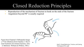 • Reproduction of the mechanism of fracture to hook on the ends of the fracture
• Angulation beyond 90° is usually required
Figure from Chapman’s Orthopaedic Surger
y 3rd Ed. (Redrawn from Charnley J. The Cl
osed Treatment of Common Fractures, 3rd e
d. Baltimore: Williams & Wilkins, 1963.)
Hak D. Closed Reduction, Traction, and Casting
Techniques.OTA. 2008
 
