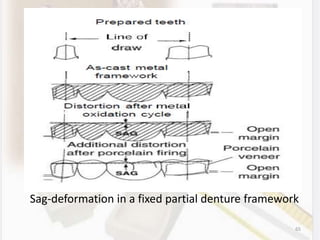 Sag-deformation in a fixed partial denture framework
65
 