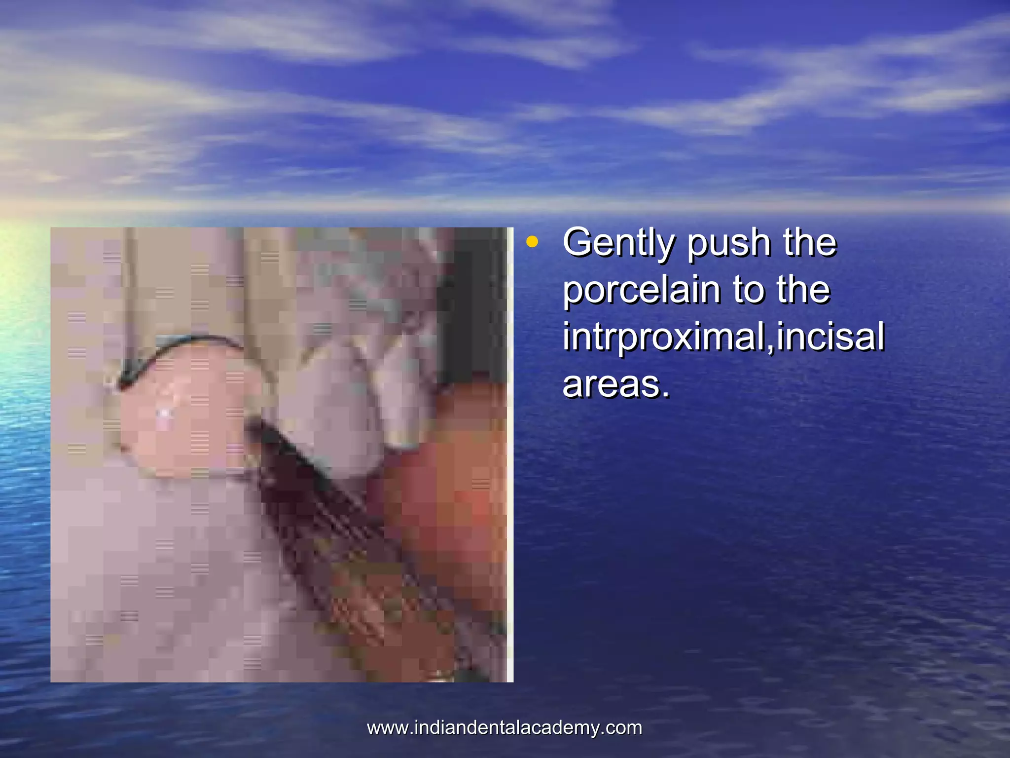 • Gently push theGently push the
porcelain to theporcelain to the
intrproximal,incisalintrproximal,incisal
areas.areas.
www.indiandentalacademy.comwww.indiandentalacademy.com
 