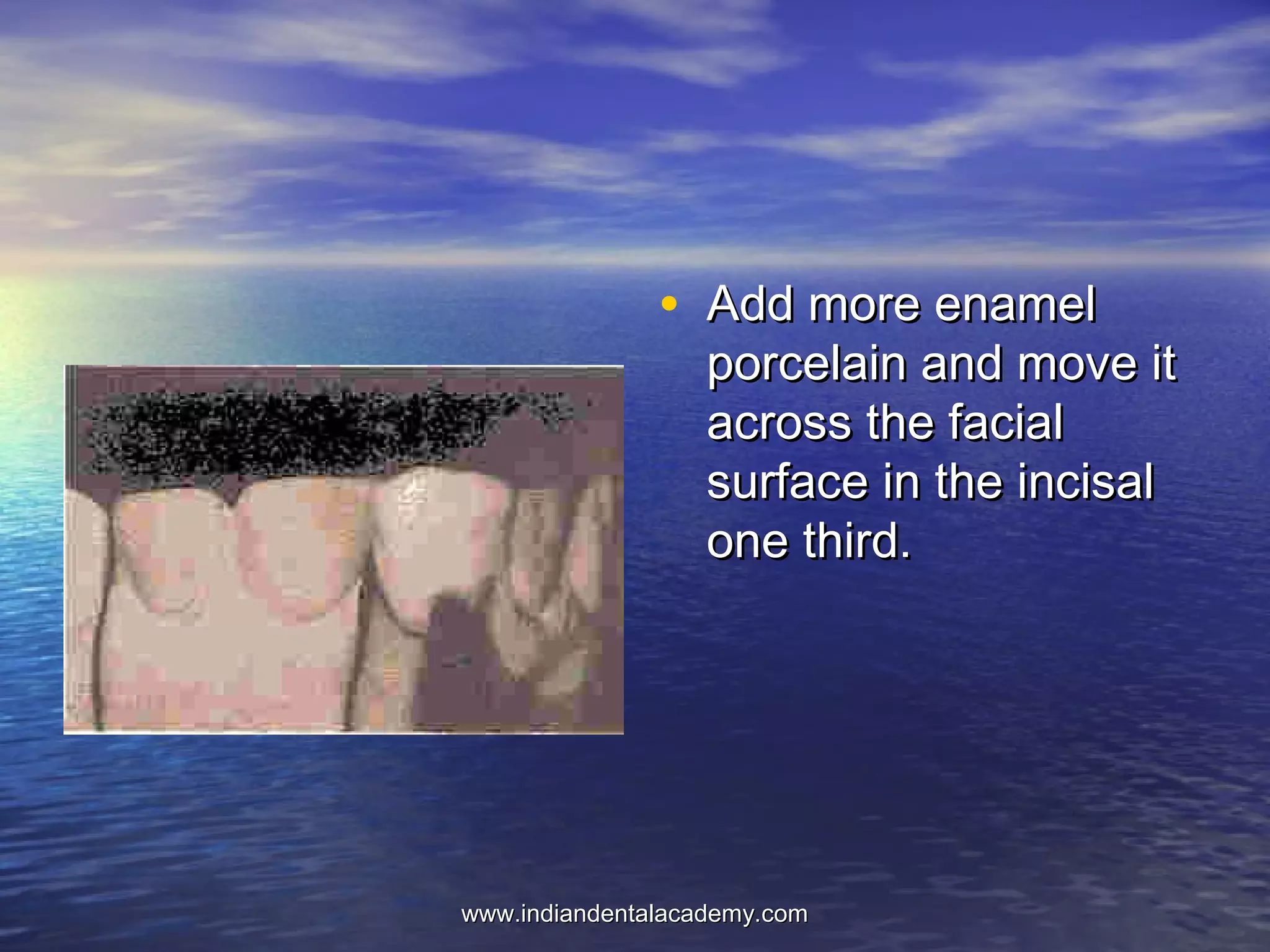 • Add more enamelAdd more enamel
porcelain and move itporcelain and move it
across the facialacross the facial
surface in the incisalsurface in the incisal
one third.one third.
www.indiandentalacademy.comwww.indiandentalacademy.com
 