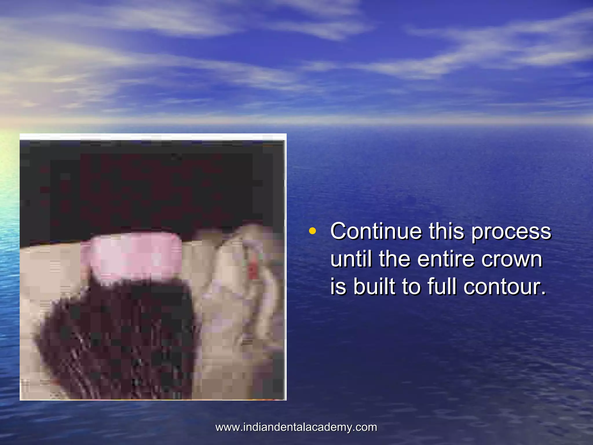 • Continue this processContinue this process
until the entire crownuntil the entire crown
is built to full contour.is built to full contour.
www.indiandentalacademy.comwww.indiandentalacademy.com
 