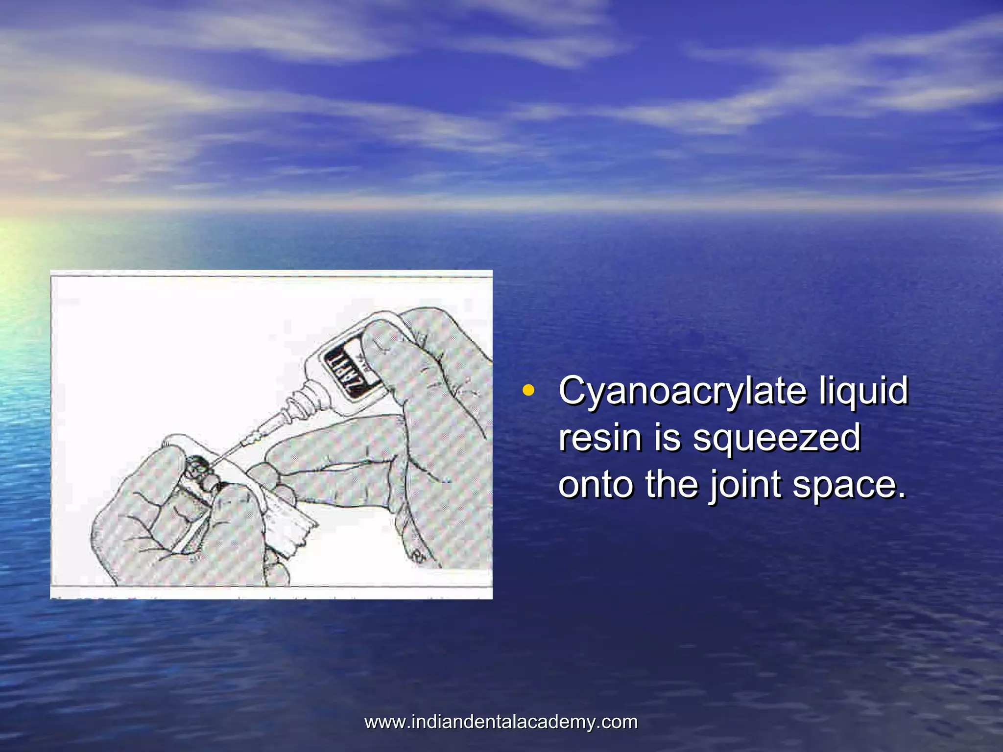 • Cyanoacrylate liquidCyanoacrylate liquid
resin is squeezedresin is squeezed
onto the joint space.onto the joint space.
www.indiandentalacademy.comwww.indiandentalacademy.com
 