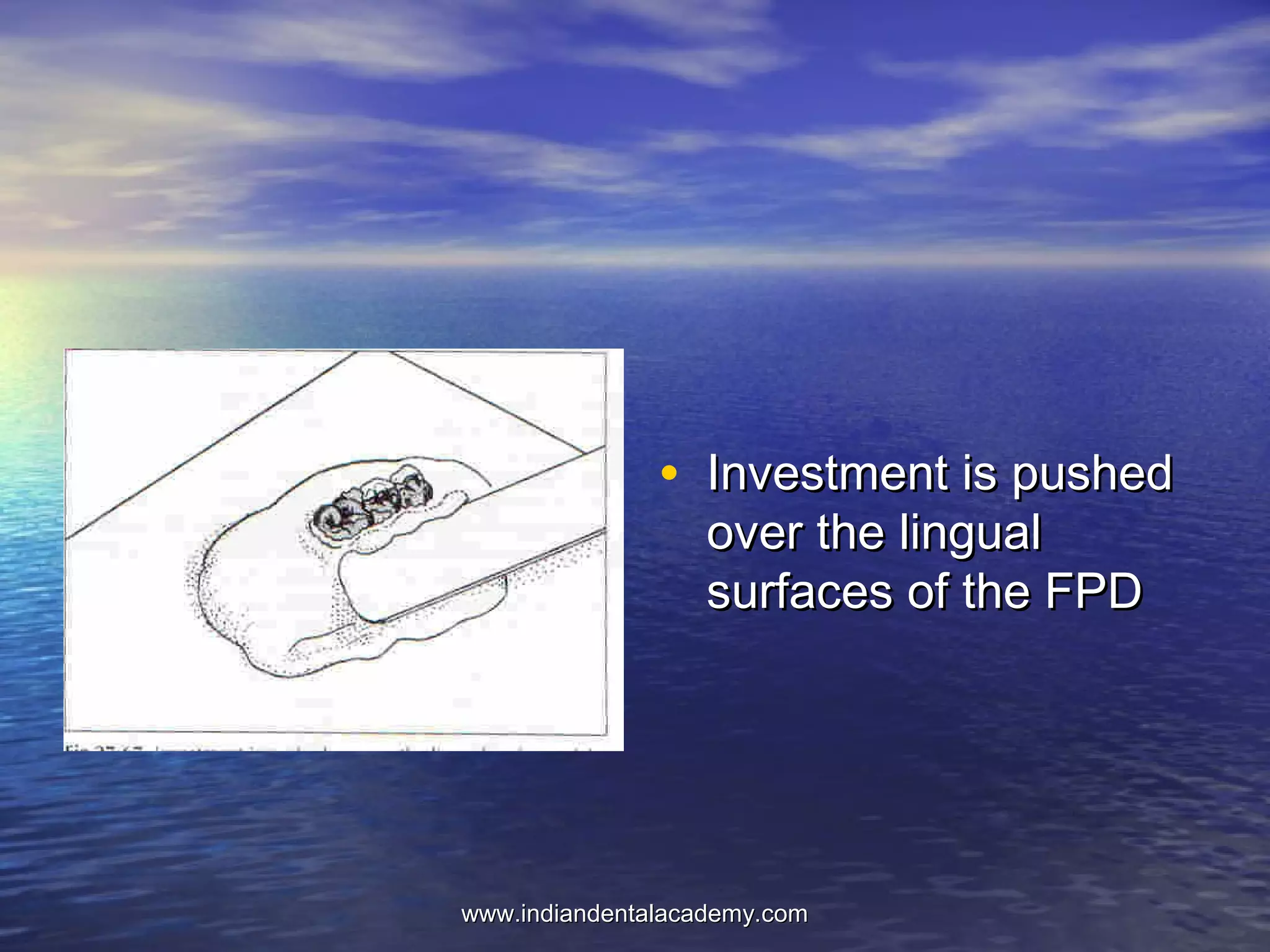 • Investment is pushedInvestment is pushed
over the lingualover the lingual
surfaces of the FPDsurfaces of the FPD
www.indiandentalacademy.comwww.indiandentalacademy.com
 
