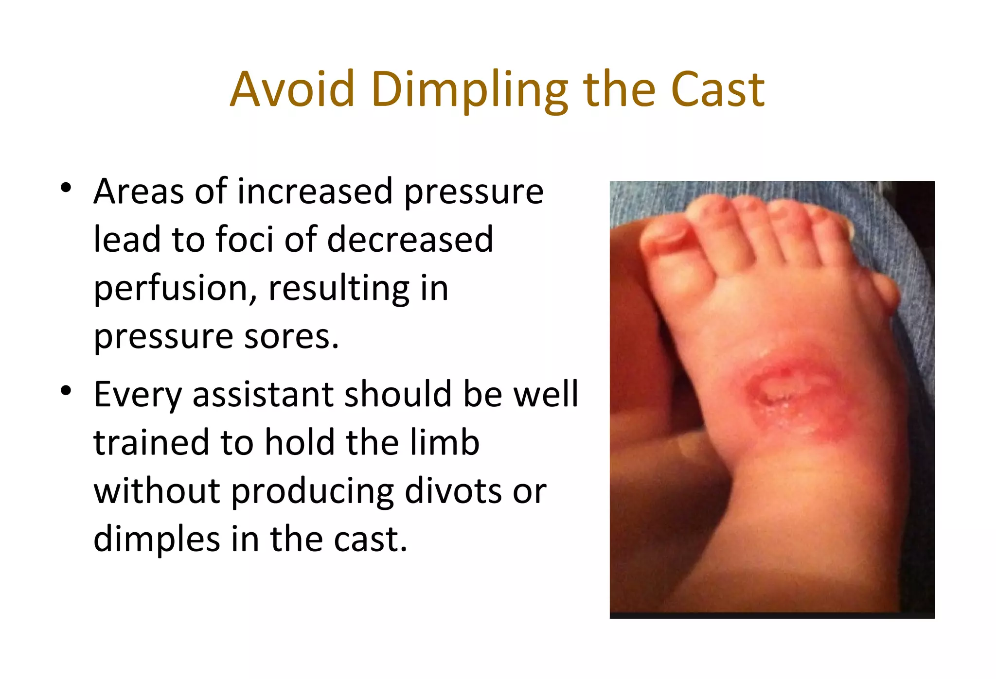 Avoid Dimpling the Cast
• Areas of increased pressure
lead to foci of decreased
perfusion, resulting in
pressure sores.
• Every assistant should be well
trained to hold the limb
without producing divots or
dimples in the cast.
 