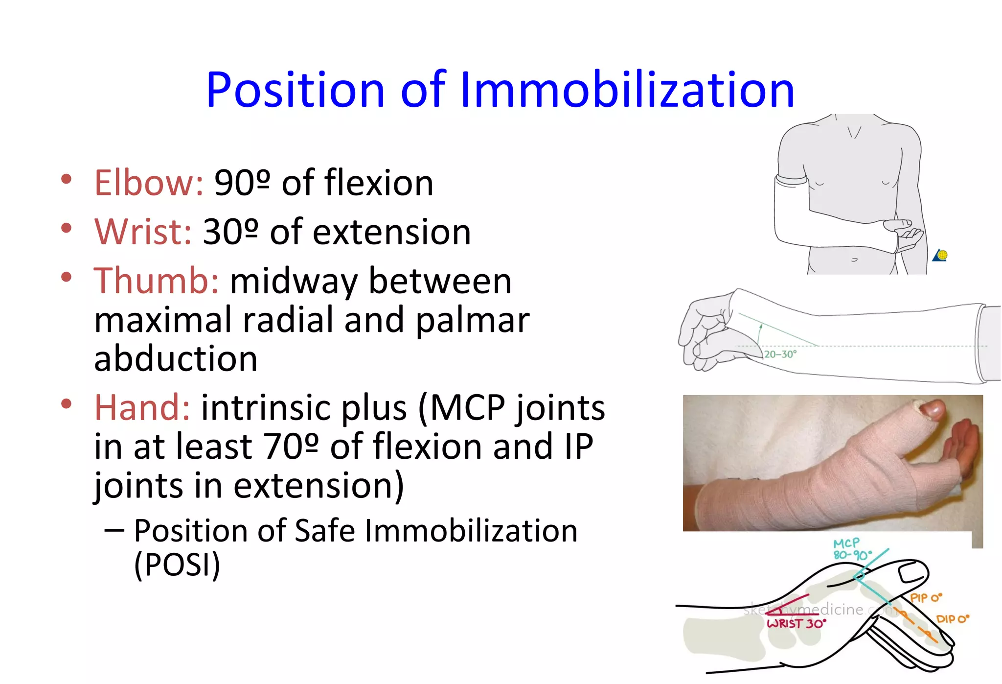 Position of Immobilization
• Elbow: 90º of flexion
• Wrist: 30º of extension
• Thumb: midway between
maximal radial and palmar
abduction
• Hand: intrinsic plus (MCP joints
in at least 70º of flexion and IP
joints in extension)
– Position of Safe Immobilization
(POSI)
 