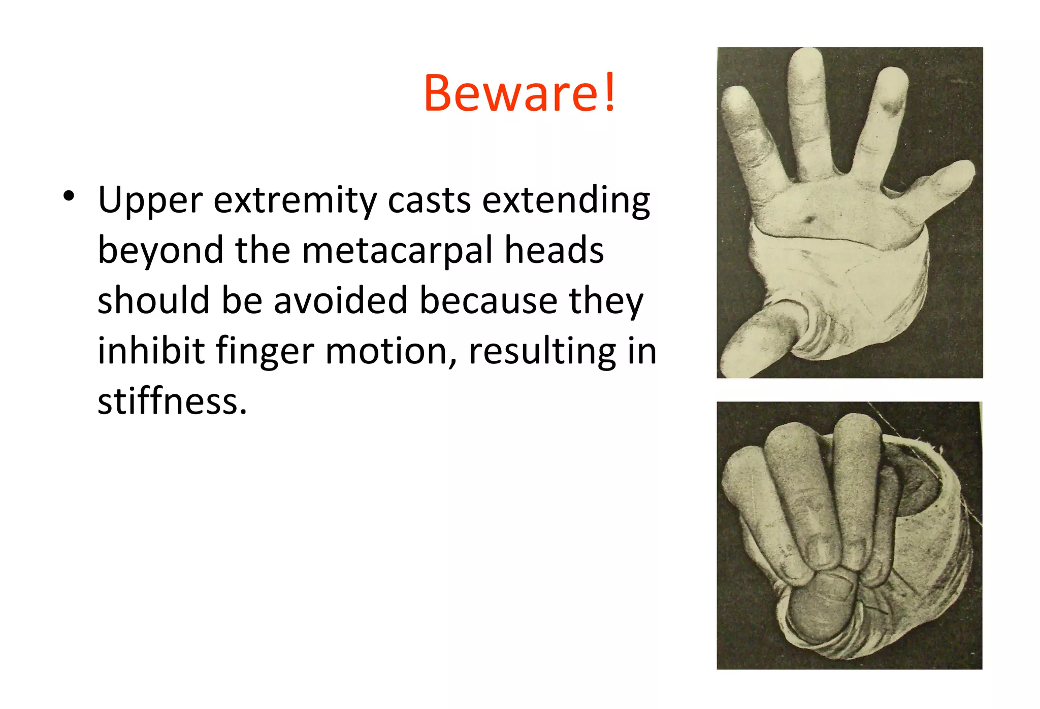 Beware!
• Upper extremity casts extending
beyond the metacarpal heads
should be avoided because they
inhibit finger motion, resulting in
stiffness.
 