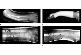 Serial Cast Finger Casting and splinting principles and common pitfalls | PPT