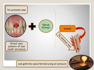 Sprue
former
his process was
Direct wax
pattern of lost
tooth structure
invest
cast gold into space formed using air pressure
 