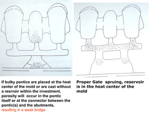 If bulky pontics are placed at the heat
center of the mold or are cast without
a resrvoir within the investment,
porosity will occur in the pontic
itself or at the connector between the
pontic(s) and the abutments,
resulting in a weak bridge
Proper Gate spruing, reservoir
is in the heat center of the
mold
 