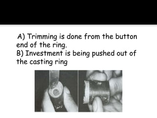 A) Trimming is done from the button
end of the ring.
B) Investment is being pushed out of
the casting ring
 