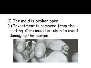 C) The mold is broken open.
D) Investment is removed from the
casting. Care must be taken to avoid
damaging the margin
 