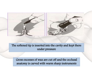 The softened tip is inserted into the cavity and kept there
under pressure
Gross excesses of wax are cut off and the occlusal
anatomy is carved with warm sharp instruments
 