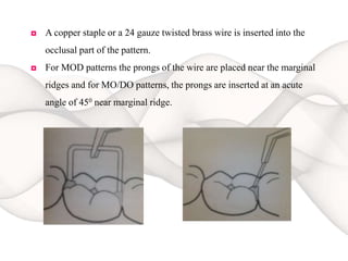◘ A copper staple or a 24 gauze twisted brass wire is inserted into the
occlusal part of the pattern.
◘ For MOD patterns the prongs of the wire are placed near the marginal
ridges and for MO/DO patterns, the prongs are inserted at an acute
angle of 450 near marginal ridge.
 