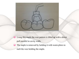  Using this staple the wax pattern is lifted up with a direct
pull parallel to cavity walls.
 The staple is removed by holding it with warm pliers to
melt the wax holding the staple.
 