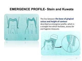 EMERGENCE PROFILE- Stein and Kuwata
The line between the base of gingival
sulcus and height of contour
described as emergence profile, which is
a straight line which faciliates, access for
oral hygiene measures
21
 