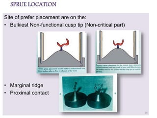 SPRUE LOCATION
Site of prefer placement are on the:
• Bulkiest Non-functional cusp tip (Non-critical part)
• Marginal ridge
• Proximal contact
26
 