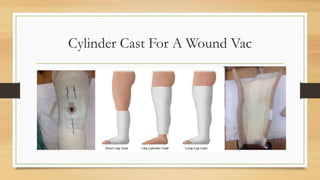 Casting splinting and bracing for wounds | PPT