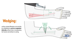 Casting and Splinting presentation for orthopedic residency | PDF
