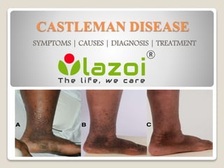 CASTLEMAN DISEASE
SYMPTOMS | CAUSES | DIAGNOSIS | TREATMENT
 