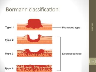 Boreman Classification ca stomach-1.pptx,an said that understand the concept difference | PPTX